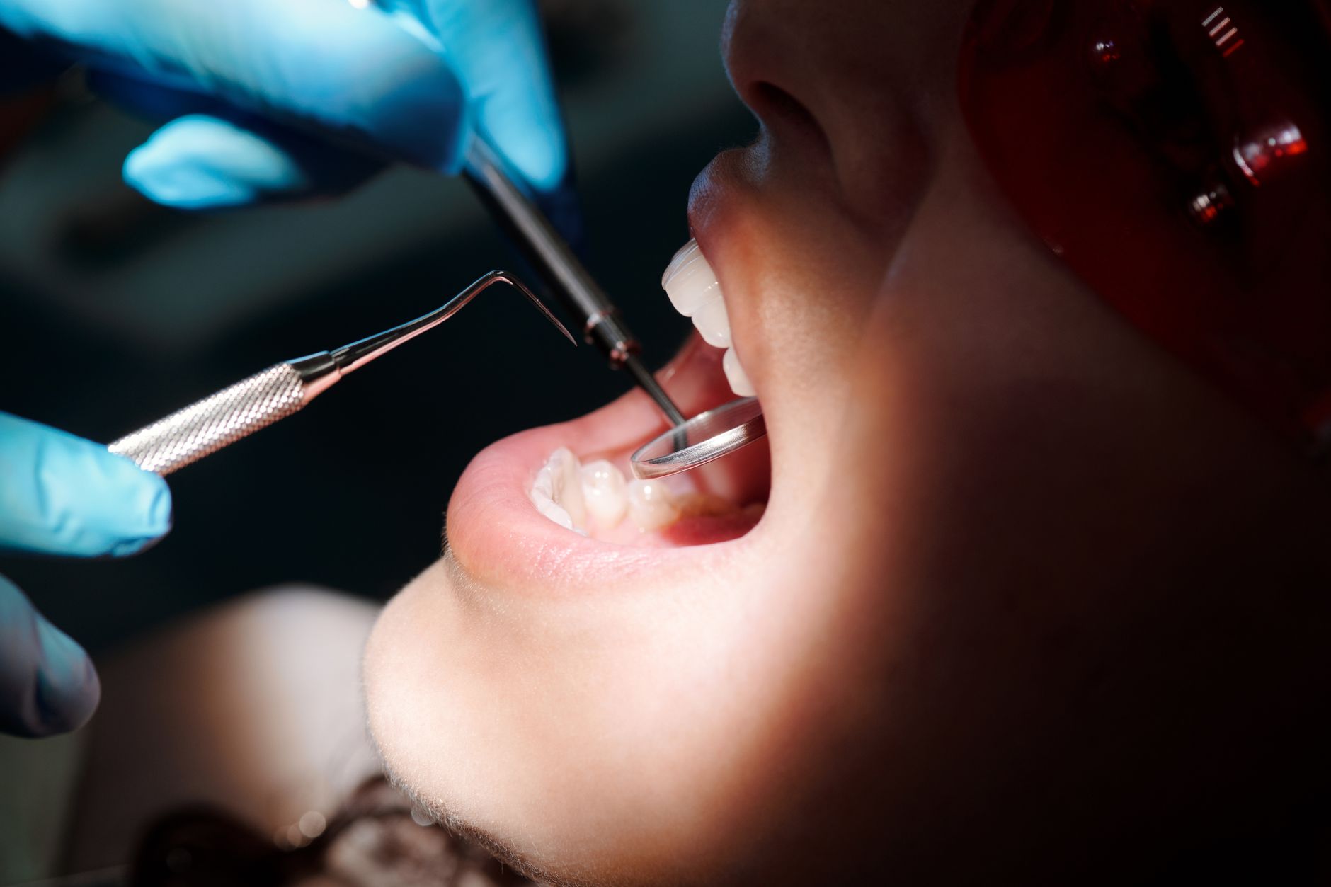 dentist treating tooth cavity